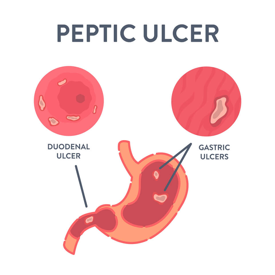 stomach ulcer treatment over the counter